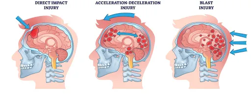 Concussion Rehabilitation