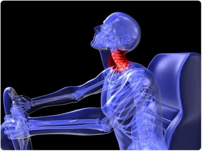 Whiplash Associated Condition